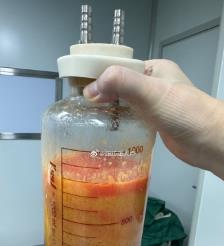 无锡水动力吸脂手术要做多久？